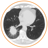 Image of a lung screening
