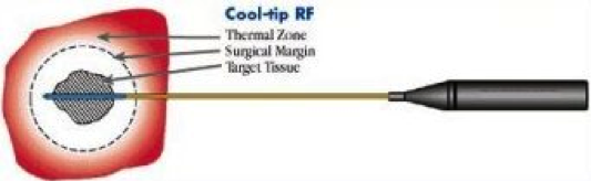 Cool-tip RF