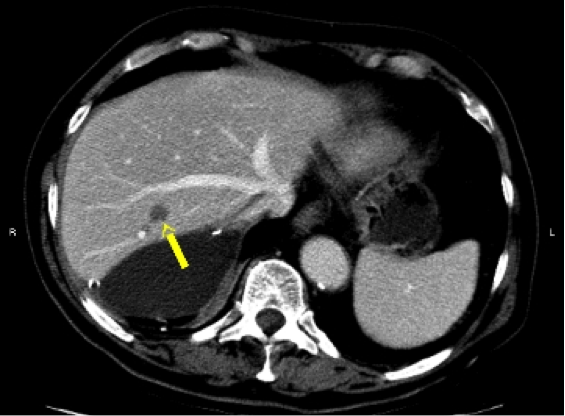 CT scan of liver