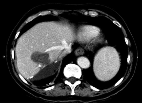 CT scan after RF ablation