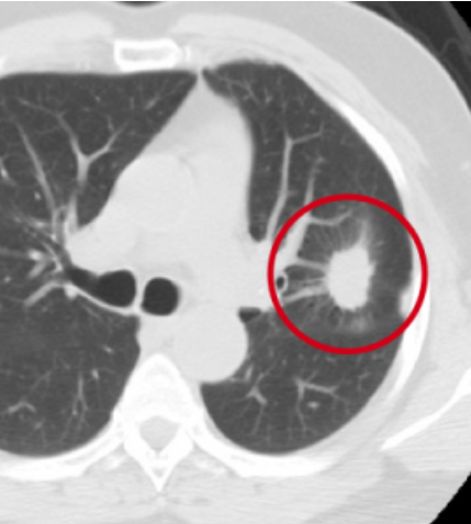 lung cancer cat scan