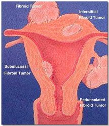 Uterus illustration