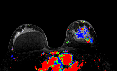 Breast MRI