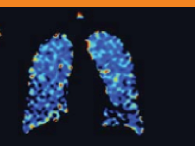 Lung image