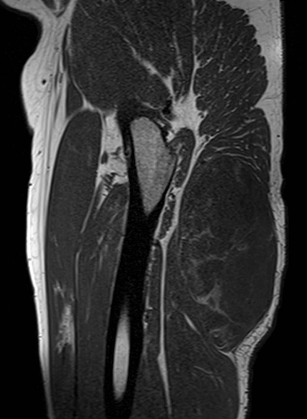 MSK tumor