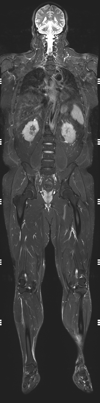 MSK tumor