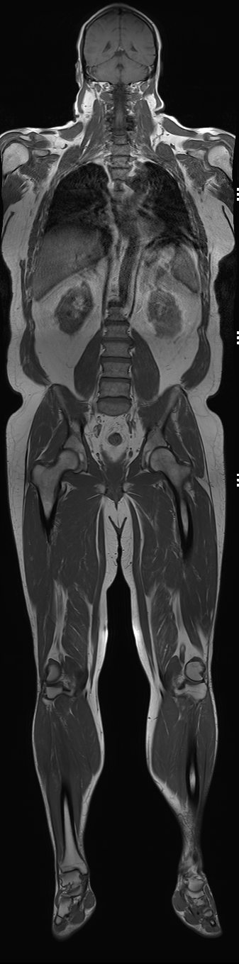 MSK tumor