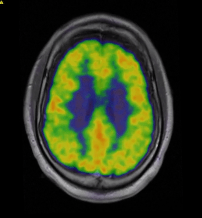 neuroendocrine tumor