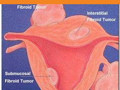 Uterine fibroid diagram