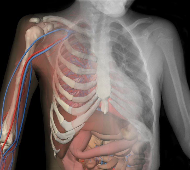 Graphic rendering of a chest x-ray with the brachial arteries and veins colored in