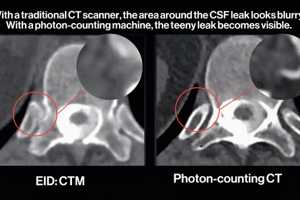 Photon Counting CT Scan Image showing CSF LEAK