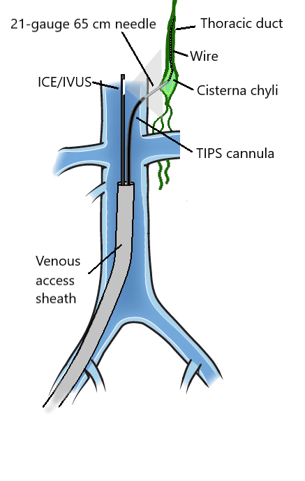 drawing of lymph system