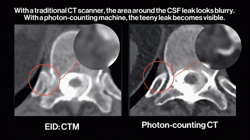 Photon Counting CT Scan Image showing CSF LEAK