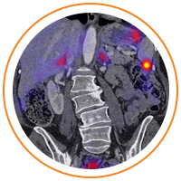 Image of a neuroendocrine tumor