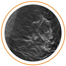 Photo of mammography scan image