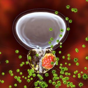 Prostate cancer graphic 