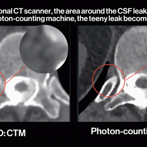 Photon Counting CT Scan Image showing CSF LEAK